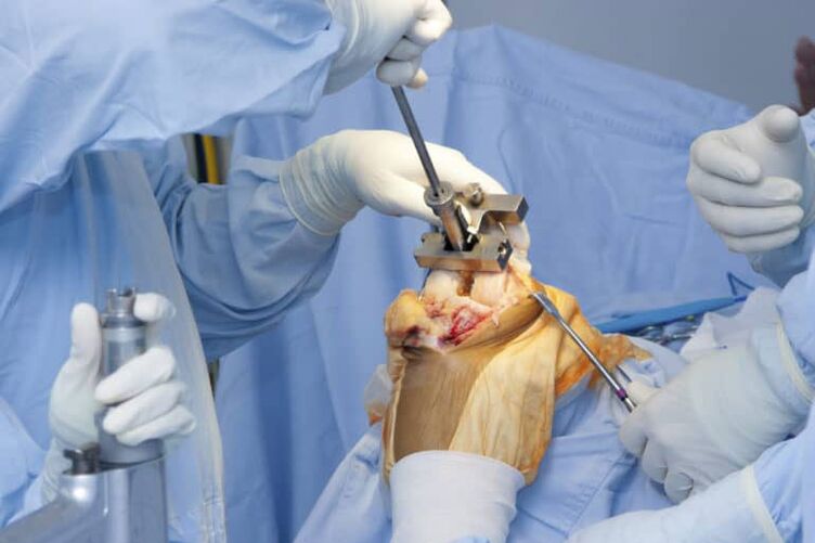 Kniearthrose Operation