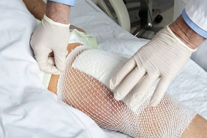 Therapeutische Kompresse bei Arthrose des Kniegelenks