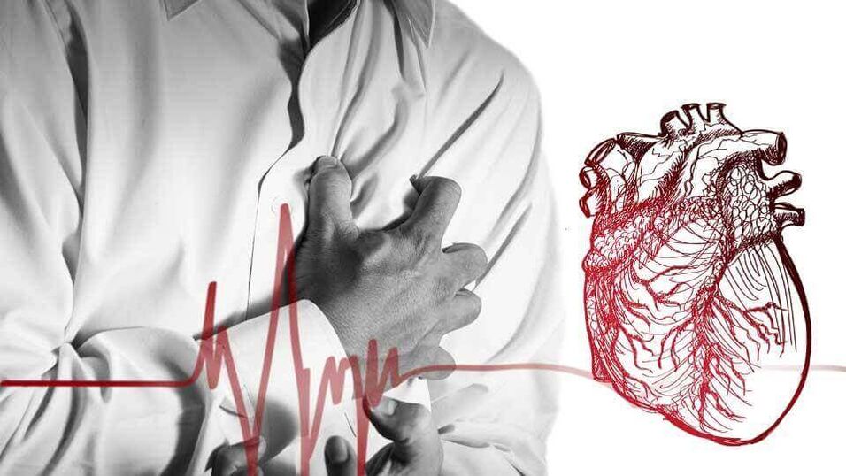 Aufgrund einer Herzrhythmusstörung bei thorakaler Osteochondrose kann es zu einer Extrasystole kommen