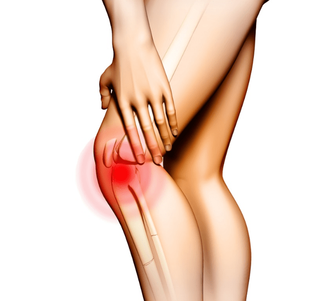 Arthrosestadien