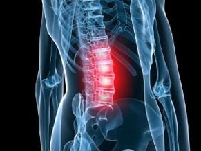 Osteochondrose der Lendenwirbelsäule