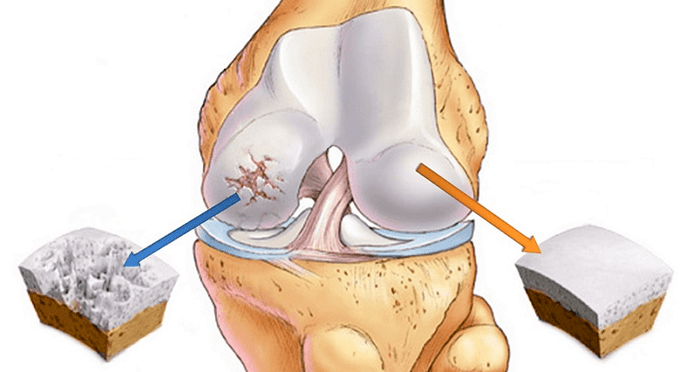 gesunder und von Arthrose betroffener Knorpel