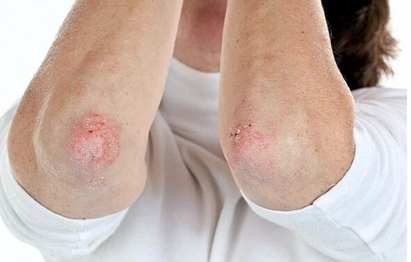 Menschen mit Psoriasis sind anfällig für Psoriasis-Arthritis