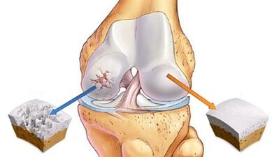 Die Gründe für die Entwicklung der Arthrose der Gelenke