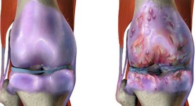 Die Hauptunterschiede von Arthritis und Arthrose