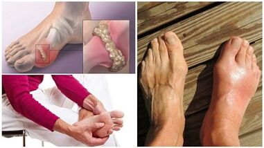Was ist Arthritis der Gelenke